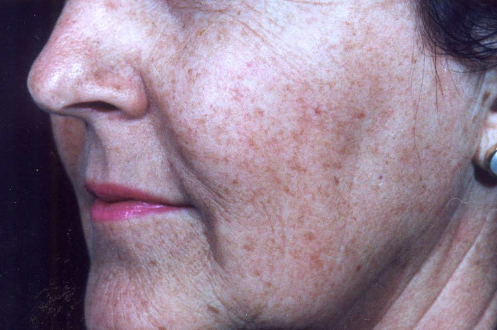 ageing-before