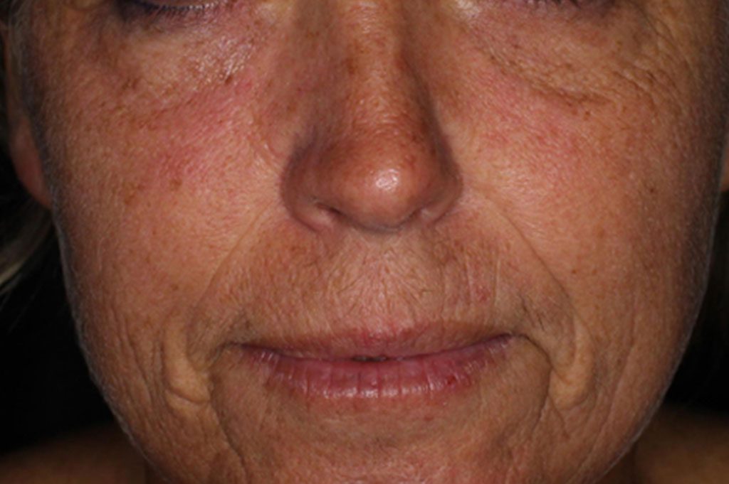 moisture-boost-cool-peel-before