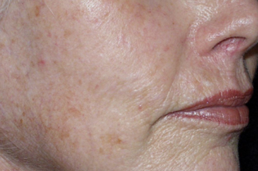 sun-damage-before