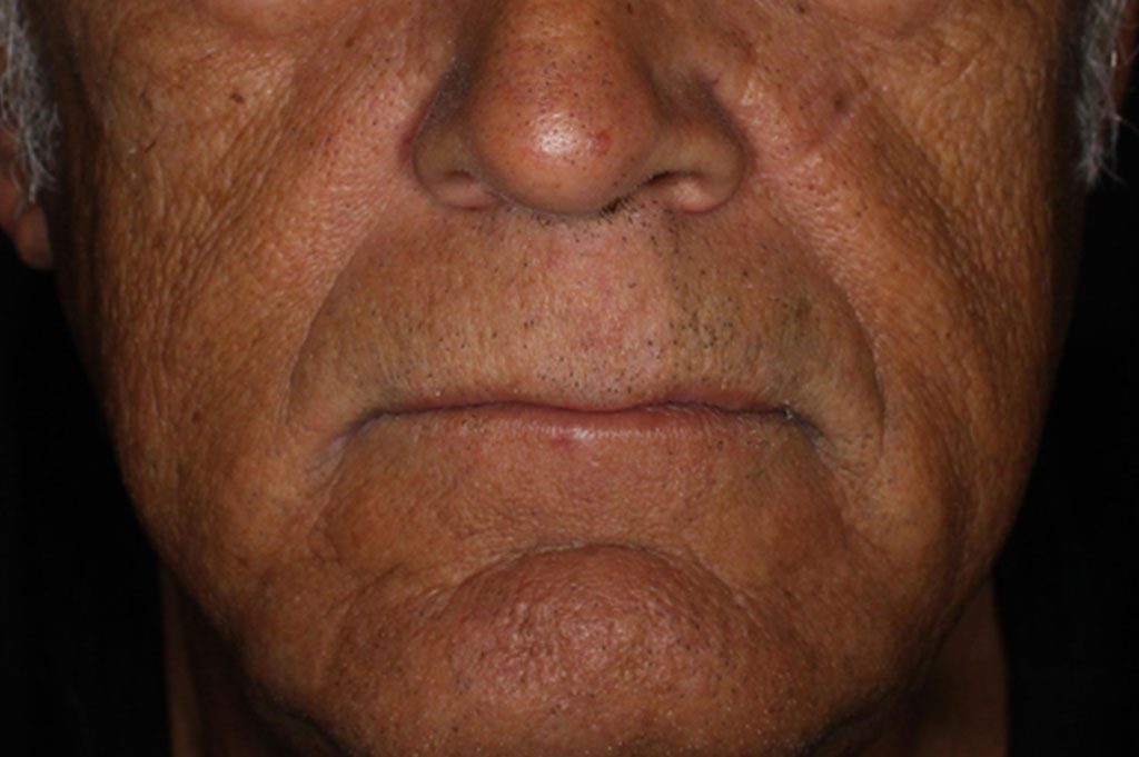 vibrant-c-micro-peel-before.jpg